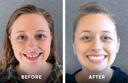 Invisalign® Before & After Invisalign clear aligners before and after